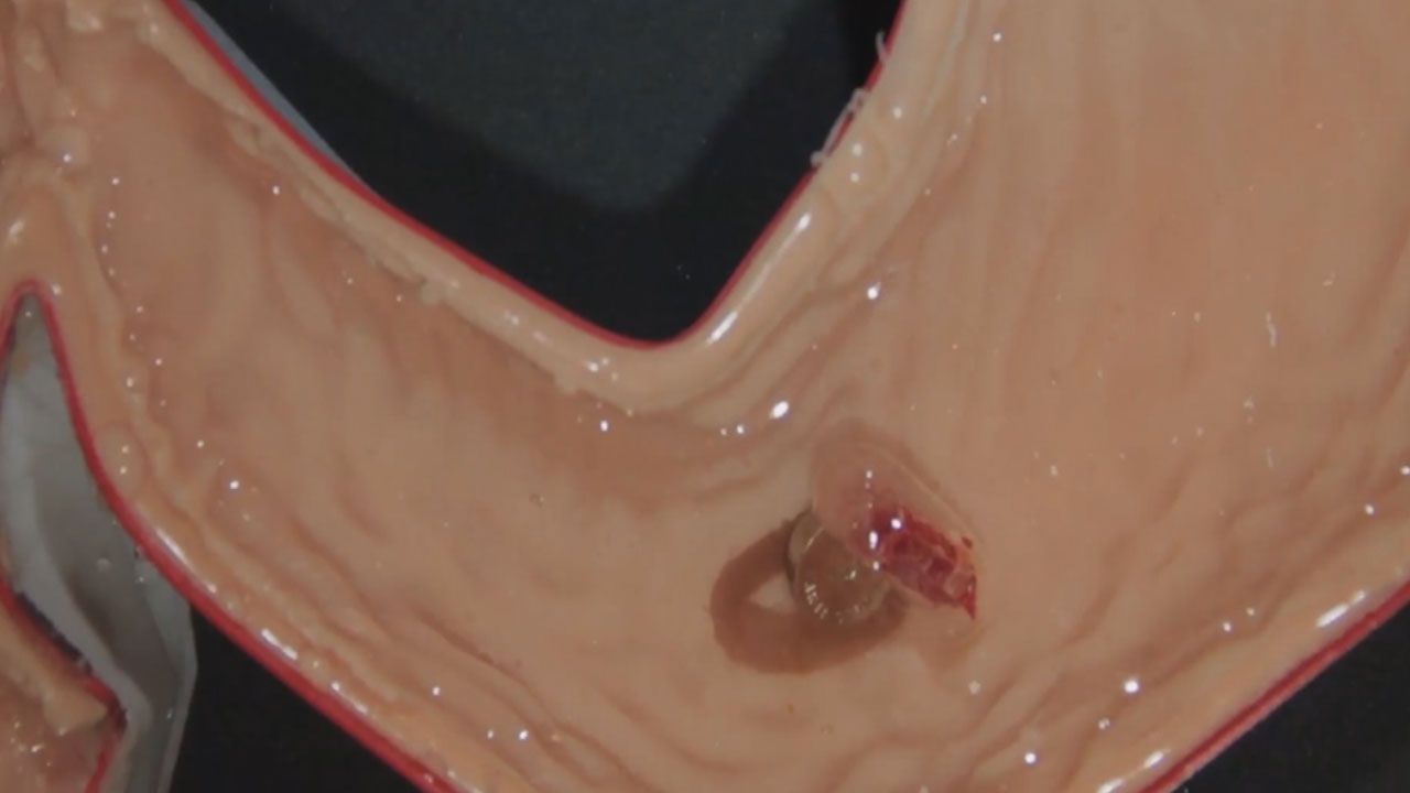 Tiny Robot Can Remove Swallowed Button Batteries